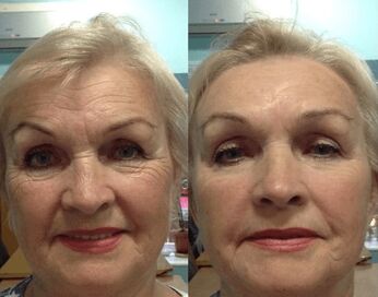 Goji Cream kullanma deneyimi - öncesi ve sonrası kişisel fotoğraf