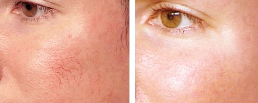 Rosacea'nın kaldırılması