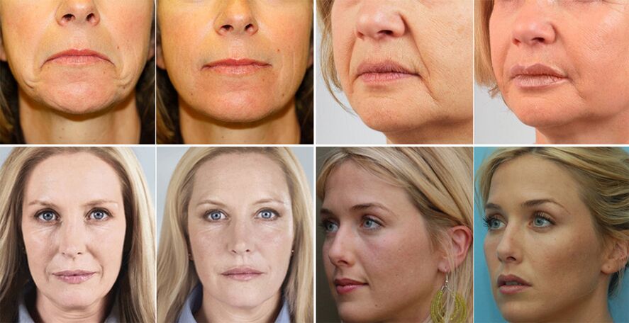 yüz cilt gençleştirme öncesi ve sonrası kadınların fotoğrafları